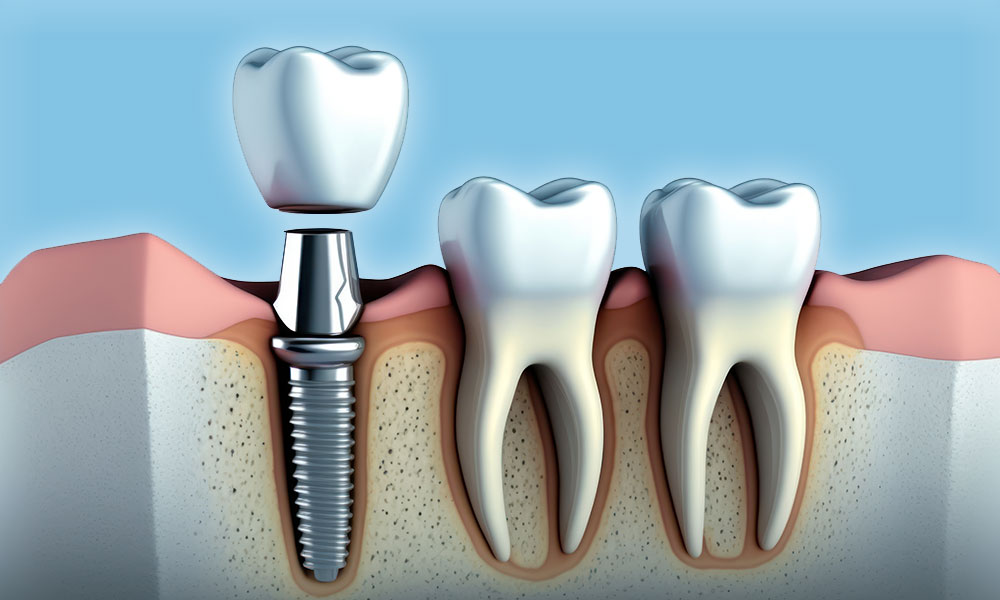 Dental Implant : Oral & Maxillofacial Ottawa