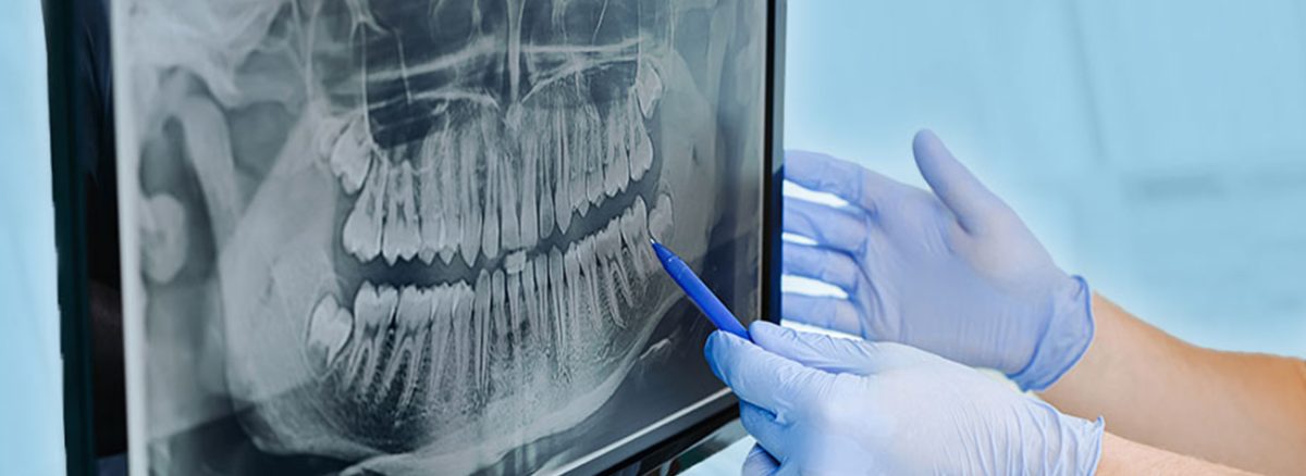 Understanding Wisdom Teeth: Why and When They Need to Be Removed