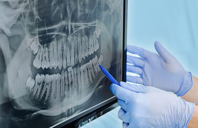 Understanding Wisdom Teeth: Why and When They Need to Be Removed