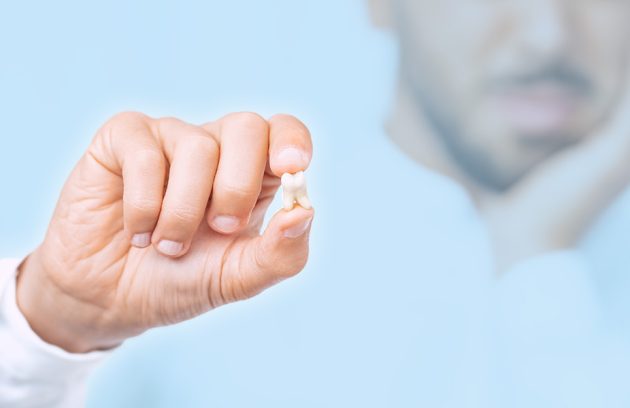 FAQs: Addressing Common Concerns About Wisdom Tooth Removal