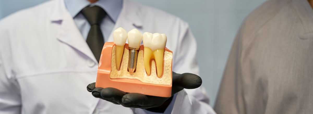 Dental Implants vs. Dentures: How to Choose the Best Option for You in Ottawa