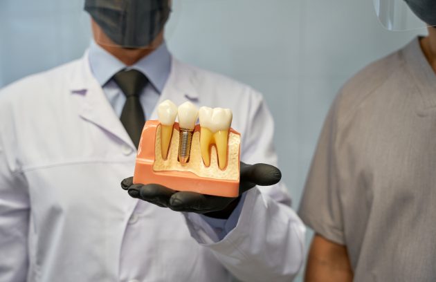 Dental Implants vs. Dentures: How to Choose the Best Option for You in Ottawa