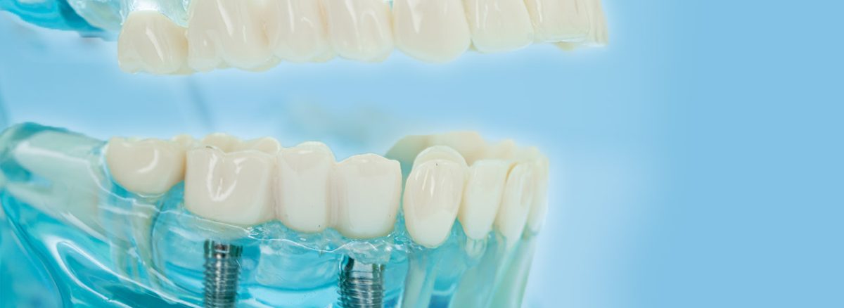 Teeth in a Day: How Ottawa Patients Are Getting New Smiles in Just One Visit
