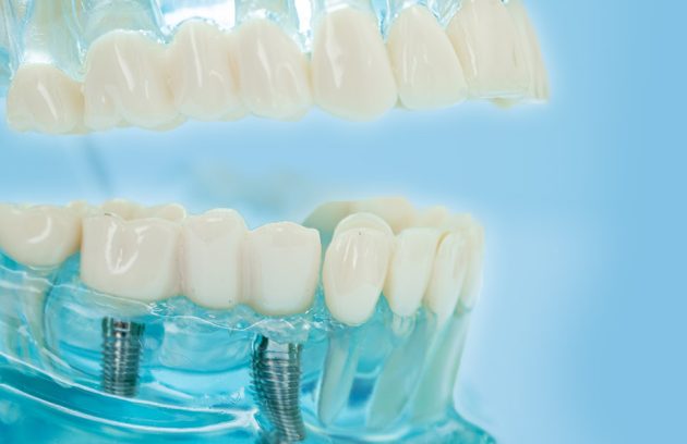 Teeth in a Day: How Ottawa Patients Are Getting New Smiles in Just One Visit