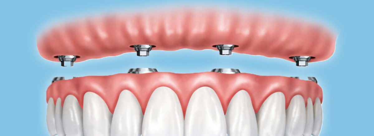 All on Four Procedure: The Truth About Teeth in a Day: Fast, Effective, and Life-Changing in Ottawa