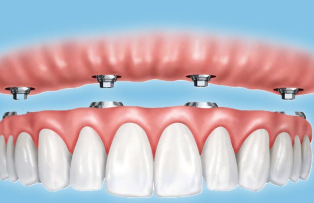All on Four Procedure: The Truth About Teeth in a Day: Fast, Effective, and Life-Changing in Ottawa