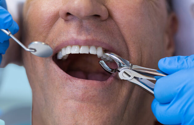 Dental Extractions in Orleans: What Patients Can Expect at Argyle Associates