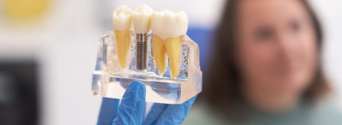 The Complete Dental Implant Timeline From Consultation to Your New Smile in Barrhaven