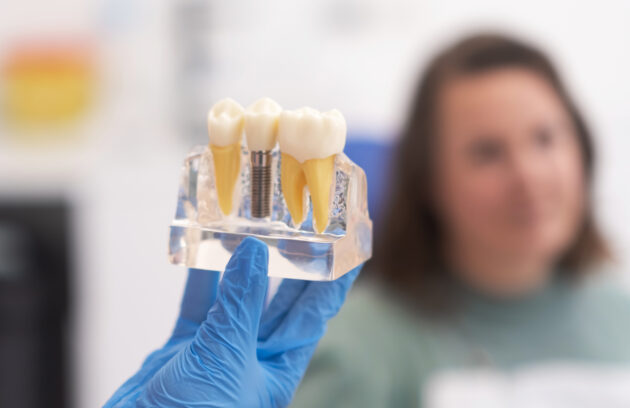 The Complete Dental Implant Timeline From Consultation to Your New Smile in Barrhaven