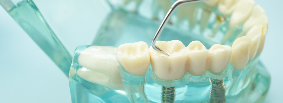 What Is the Success Rate of Dental Implants Why Choosing the Right Oral Surgeon in Barrhaven Matters