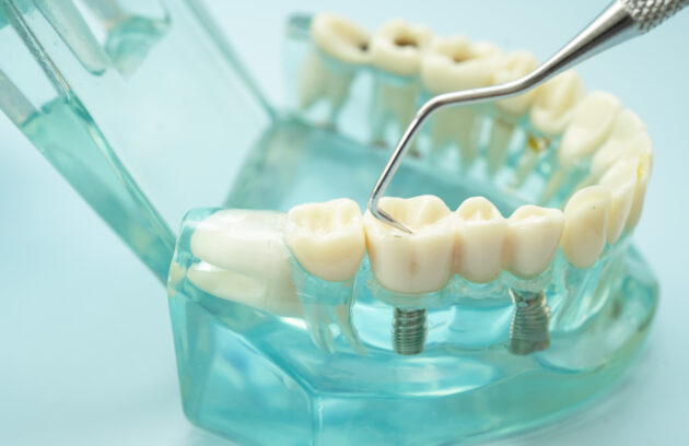 What Is the Success Rate of Dental Implants Why Choosing the Right Oral Surgeon in Barrhaven Matters